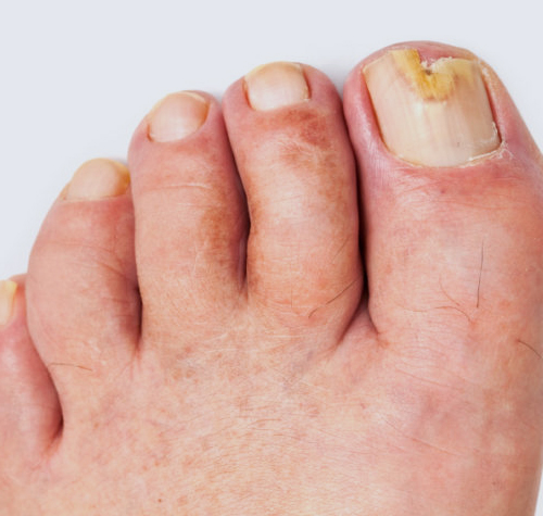  Fungal Infections